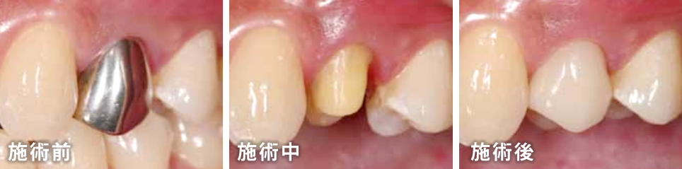 小臼歯（前歯から4番目と5番目の歯）の被せ物は保険適用可能です。